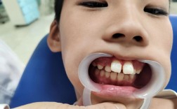 牙齿矫正后牙齿内缩，是正常现象还是需关注？