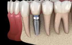 种植牙戴上后出现晃动，是种植体失败还是护理问题？该怎么处理？