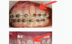 正畸后牙齿脱矿是什么原因？该如何科学预防与处理？