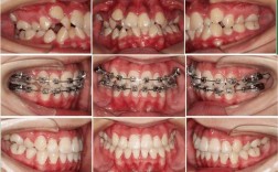 牙齿矫正过程是怎样的？关键步骤和注意事项有哪些？