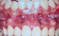 矫正牙齿前后的图片