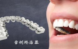 数字化舌侧矫正如何实现精准高效与舒适兼顾？