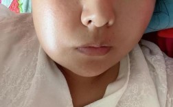 牙齿矫正后牙龈肿