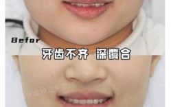 牙齿矫正后咬合不好，是什么原因导致的？该如何处理？