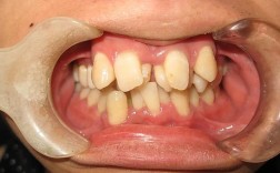 牙齿稀疏正畸失败