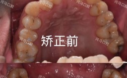 23岁还可以牙齿矫正