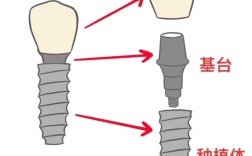 口腔种牙基台图片通常包含哪些类型和特点？