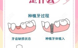 缺失三颗牙该怎么种？种植牙的具体步骤、适用条件、费用及术后护理全解析