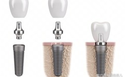 广州植牙价钱柏德