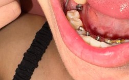 矫正牙齿附件掉落了，该怎么处理？会影响矫正效果吗？