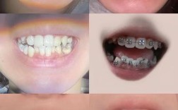 牙齿矫正前后效果图效果如何？变化大不大？