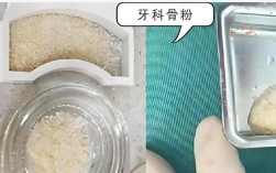 种牙骨膜是啥？种植牙中它到底起什么关键作用？