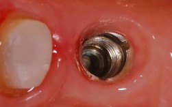 人工种植牙种植体种入的详细操作步骤和注意事项是什么？