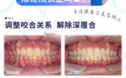 双颌前突手术两种方法有何区别及如何选择？