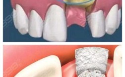 种牙植骨后骨粉为什么会漏出？这种情况会对种植牙效果产生哪些影响？又该如何正确处理和预防？