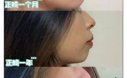 牙齿矫正嘴巴会变小吗