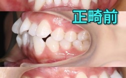 正畸每月历程图片