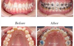 牙齿不齐必须正畸吗？不矫正会有什么影响？