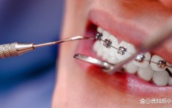 德伦种牙视频效果如何？种牙过程靠谱吗？