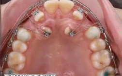 正畸垂直牵引图片