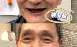 种牙后血压低是何原因？正常吗？