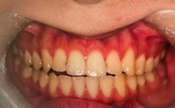 成人牙齿矫正后，会出现哪些后遗症？