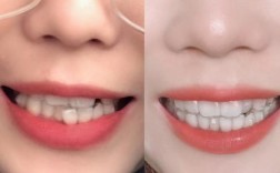 隐形牙套摘带方法6，第6期如何正确摘戴？