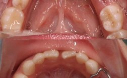 正畸真的会导致牙齿过早脱落吗？