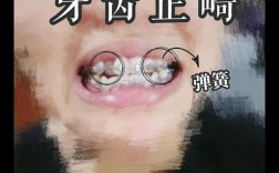 牙齿矫正上弹簧