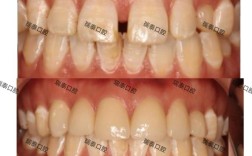 矫正牙齿收牙缝会疼吗？过程难受吗？