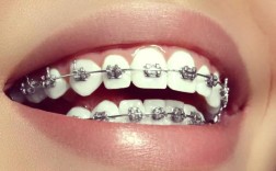 牙齿矫正托槽是什么？矫正中托槽的作用是什么？