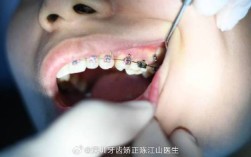 正畸种植钉松动，口外弓使用是诱因吗？