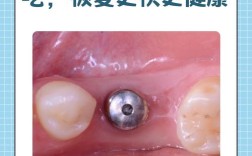 微创种牙哪里找？靠谱机构和渠道有哪些？