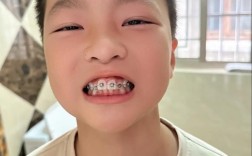 矫正下牙和上牙矫正，关键差异有哪些？