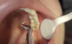 取出侧穿牙胶尖的方法