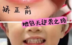 小孩骨性龅牙能正畸吗