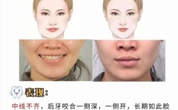牙齿矫正会改变脸型么