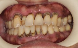 苏州牙周炎种牙贴吧，牙周炎种牙前需治疗吗？流程和费用怎样？