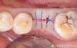 种牙愈合基台流血正常吗？需要处理吗？