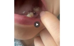 种牙植骨粉后照片能看出恢复效果吗？