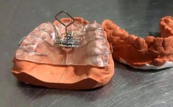 正畸螺旋扩弓器拆解