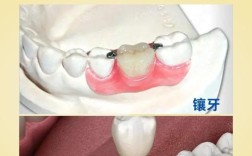 30岁种牙好还是镶牙好