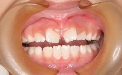 儿童牙齿矫正真的会痛吗？