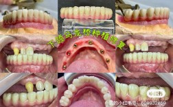 半口牙缺失做种植牙的流程是怎样的？步骤和注意事项有哪些？