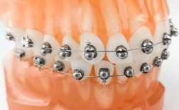 进口牙齿矫正托槽价格为何差异大？影响因素有哪些？