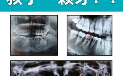 牙周炎影像检查方法有哪些？不同影像学检查手段（如X线片、CBCT等）在诊断中各有何优势和适用场景？