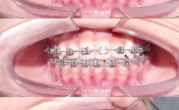 牙齿矫正中途能换医院吗？