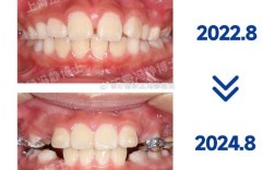 矫正牙齿中线不齐