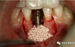 种骨和植牙全过程是怎样的？种骨是植牙的必经步骤吗？两者具体操作步骤、注意事项及术后效果差异有哪些？