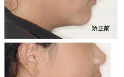 下颌牙正畸后唇倾